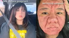 Mujer expone cambio extremo en su rostro durante su embarazo y cómo afectó su autoestima: "No me reconocía"