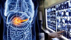 Científicos chinos logran detectar cáncer de páncreas con inteligencia artificial y recibe aprobación de la FDA