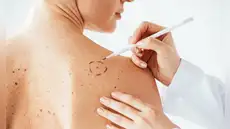 Avance contra el cáncer de piel: investigadores argentinos crean una vacuna para tratar el melanoma y ya está disponible