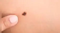 El melanoma en Perú: cómo reconocer a tiempo el cáncer de piel más agresivo