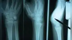 Estudio científico descubre proteína clave para la reparación de huesos después de sufrir una fractura