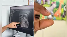 Niña de 6 años sobrevive a perforación intestinal tras ingerir pila de reloj