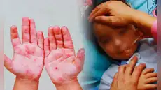 Alerta en el norte del Perú por brote de virus Coxsackie: reportan más de 30 casos de la infección viral "mano, pie y boca"