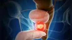 Ensayo clínico internacional demuestra eficacia de terapia combinada en cáncer de próstata agresivo: menos progresión y menor mortalidad