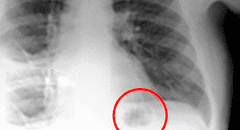 Creyó que una mancha en sus pulmones era cáncer, pero se llevó tremenda sorpresa al descubrir la verdad [FOTO]