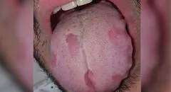 COVID-19: pacientes presentan lesiones en lengua y manchas en la piel