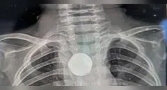 Niño de un año se traga una pila y sobrevive 5 semanas con el objeto atascado en su esófago