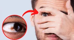 ¿Por qué aparecen lunares en los ojos, qué significan y cuándo deben ser eliminados?