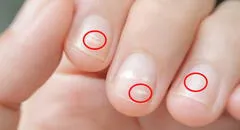 ¿Alguna vez te salieron manchas blancas en las uñas? Conoce cuál es su origen y cómo eliminarlas