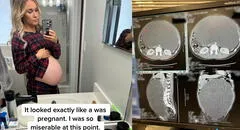 Mujer lucía como embarazada a pesar de dar a luz meses antes: tenía un quiste de 9 kilos