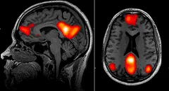 Inteligencia artificial puede detectar el Parkinson años antes de que aparezcan los síntomas