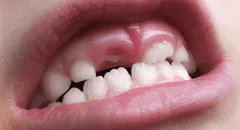 Así funciona el fármaco experimental que podría regenerar los dientes caídos