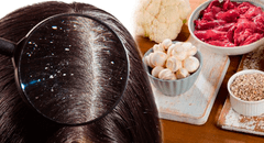 ¿Qué vitamina ayuda a prevenir la caspa y combate la pérdida de cabello?