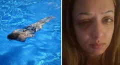 Mujer acudió a nadar a piscina pública y perdió la visión en un ojo: “El dolor más insoportable”