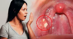 ¿Por qué me salen bolitas amarillas en la garganta y cómo puedo eliminarlas para no tener mal aliento?