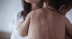 ¿Por qué el caso de sarampión importado detectado en Perú preocupa tanto a los científicos?