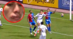 Así quedó el rostro del jugador de Melgar tras el codazo que recibió, por el que no cobraron penal