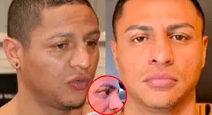 Jonathan Maicelo impacta a usuarios con radical cambio tras operación a la nariz: así luce ahora el boxeador