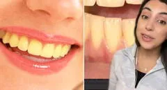Dentista revela la verdadera razón detrás de los dientes amarillos, ¡aunque te cepilles diario!
