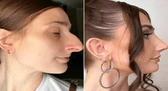 Joven en Estados Unidos ahorró más de 10 años para una rinoplastia que le cambió la vida: "Me llamaban bruja"