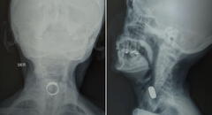 Mujer de 85 años comió un anillo mientras dormía: soñó que era caramelo y terminó internada en hospital de Lima