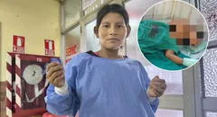 Iquitos: niña de 4 años con graves quemaduras al caerle olla de caldo hirviendo