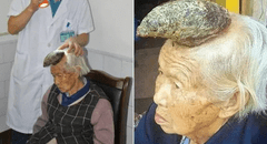 El insólito caso de la "abuela unicornio", la mujer china a la que le creció un cuerno de trece centímetros en la frente