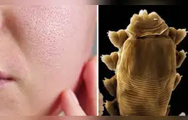 ácaros en la cara, ácaros en la piel