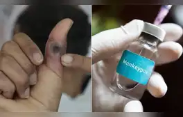 Alerta por viruela del mono: conoce las zonas más afectadas en Perú, vacuna, dosis y efectos secundarios