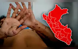 Viruela del mono continúa en aumento diario en el Perú: cifras, regiones más afectadas y todo lo que se sabe