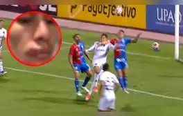 Así quedó el rostro del jugador de Melgar tras el codazo que recibió, por el que no cobraron penal