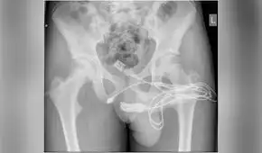 Operan a adolescente que se introdujo un cable USB para medir su pene