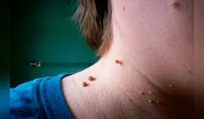 ¿Qué son y cómo quitar los lunares de carne o acrocordones?