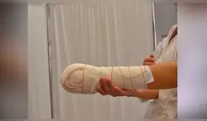 Mujer se amputa la mano con una sierra para cobrar casi 400.000 euros del seguro