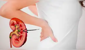 Minsa: Dos millones de personas padecen de enfermedad renal crónica en el país