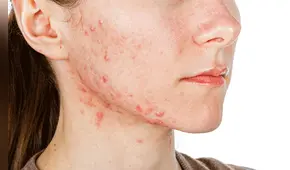 El acné y sus consecuencias