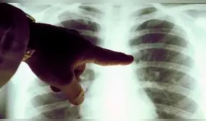 Veracruz se coloca en el primer lugar en casos de neumonía atípica en México