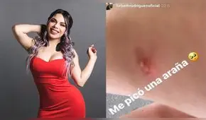 Lizbeth Rodríguez, ex ‘Chica Badabun’, preocupada por picadura de un “bicho desconocido”