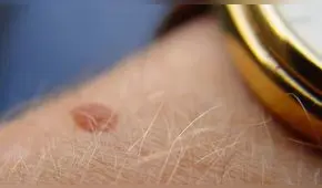 Día del Lunar: ¿cómo detectar y prevenir a tiempo las inusuales manchas en la piel? 