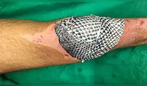 Tilapia: el pez cuya piel puede curar quemaduras y reconstruir vaginas [VIDEO]