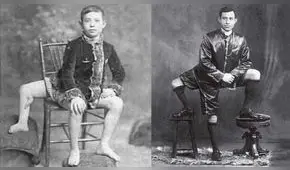 La increíble historia de Frank Lentini: ¿por qué nació con 3 piernas, 4 pies y 2 genitales?