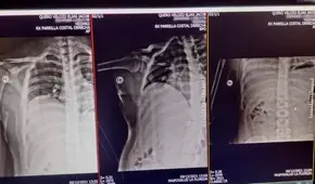 Denuncian a guardia que usó un fierro y fracturó a un joven preso por protestas en Chile