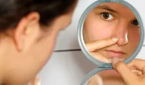 Acné: ¿qué productos caseros pueden ser peligrosos para la piel?