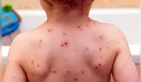 ¿Cuáles son los mitos y verdades sobre la varicela?