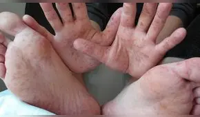 Tumbes: Diresa monitorea 13 casos sospechosos de la enfermedad de manos, pies y boca