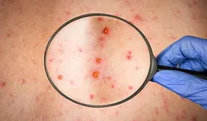 Viruela del mono en Arequipa: detectan primer caso y esperan resultados de 6 sospechosos 