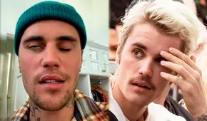 ¿Qué le pasó a Justin Bieber y en qué consiste el extraño síndrome de Ramsay Hunt que padece?