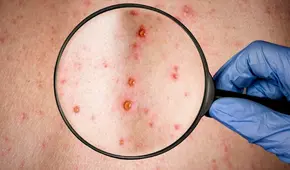 El sexo casual y tener múltiples parejas aumenta el riesgo a contagiarse de la viruela del mono