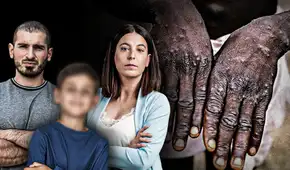 Viruela del mono se contagia por saliva y contacto cercano en hombres, mujeres y niños, aclaran especialistas Viruela del mono se contagia por saliva y contacto cercano en hombres, mujeres y niños, aclaran especialistas