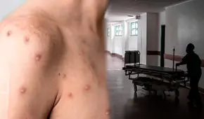 INS sobre viruela del mono: “Reducir casos significa involucrar cambios de comportamiento”